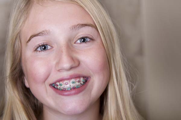 Popular Braces Options For Teens From A General Dentist