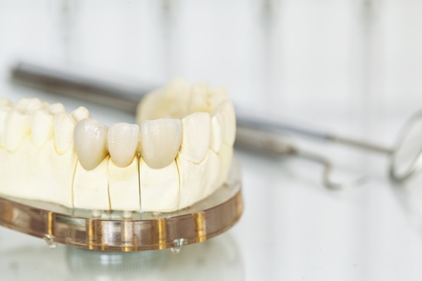 Replacing Teeth With The Help Of A Dental Bridges Dentist