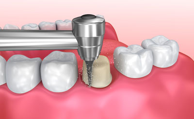 Types Of Dental Crowns That Look Natural