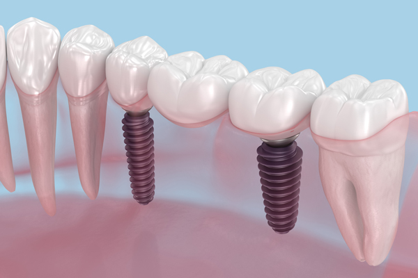 Aftercare Instructions From An Implant Dentist