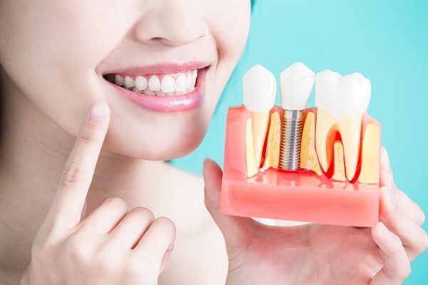Is There Special Oral Hygiene After Getting Dental Implants?