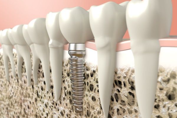 Dental Implants Are A Permanent Alternative To Dentures