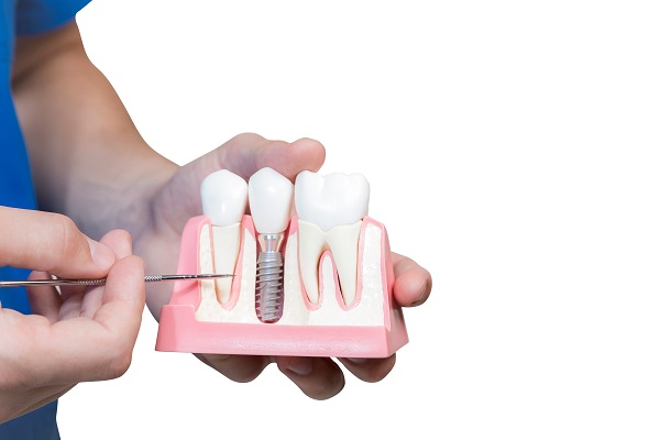 Get Dental Implants From An Experienced Implant Dentist